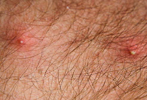 This is what inflamed lice bites look like