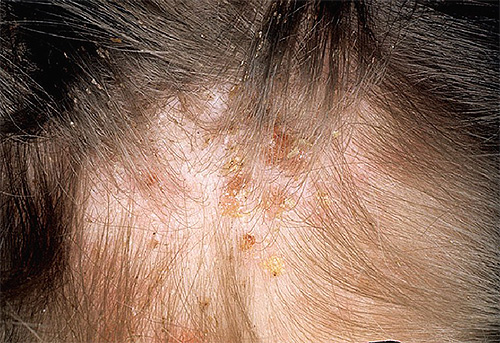 Often, lice bites are complicated by concomitant allergies and pustular inflammation.