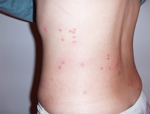 Bed bugs, biting a person, often leave a characteristic bite path on the body.