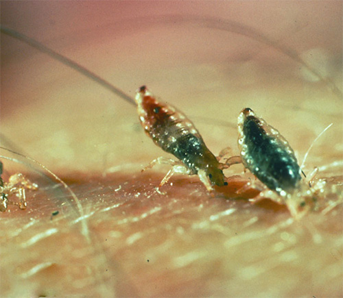 During the bite, the louse tries to plunge its stylets into the human body as deeply as possible, practically plunging its head into it