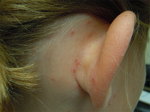 The photo shows combed lice bites behind the ears of a child