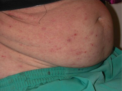 The photo shows numerous bites of body lice (linen)