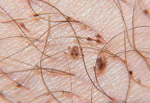 Pubic lice and their nits