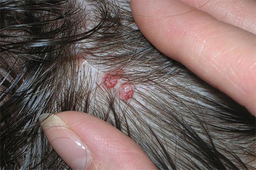 Scratching lice bites can develop into serious pyoderma