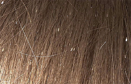 Whitish-colored nits are especially visible on dark hair.