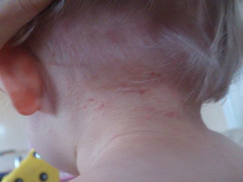 The red dots are clearly visible in the photo - places of lice bites on the child's neck