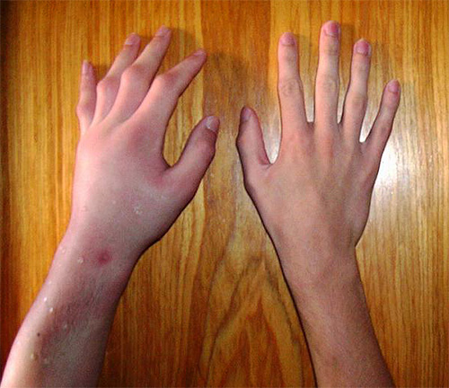 Even if the bite site is swollen and itchy, it often goes away quite quickly without any consequences.
