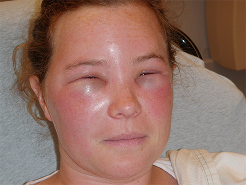 Drinking plenty of fluids helps reduce signs of intoxication after being bitten by wasps or other stinging insects.