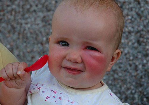 To treat a bite in a small child, you can use Gardex Baby balm.