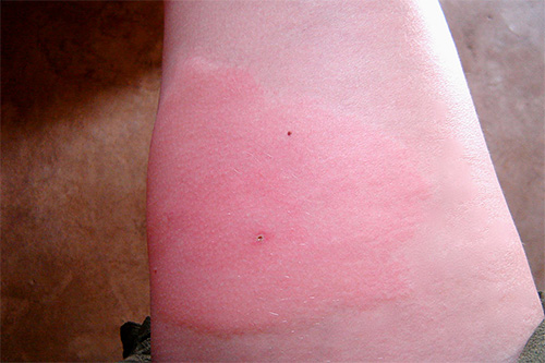 Most often, redness and slight swelling develop in the place stung by the wasp.
