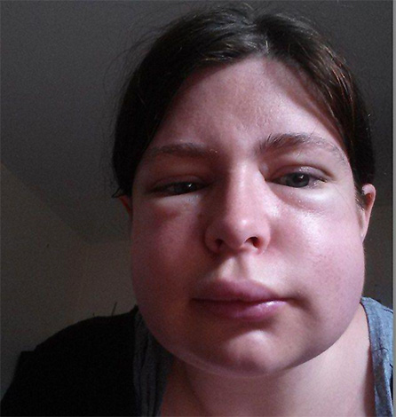 One of the most dangerous consequences of a wasp sting is rapid swelling of the larynx, which often leads to suffocation.