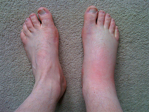 Si un insecte piqueur a mordu, par exemple, au pied, le gonflement peut se propager à toute la jambe