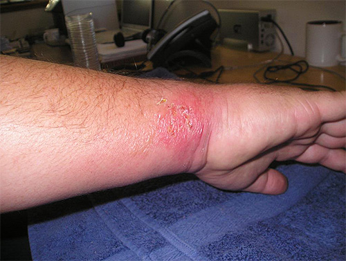 Si vous peignez constamment le site de piqûre de guêpe, il y a une forte probabilité d'introduire une infection dans la plaie.