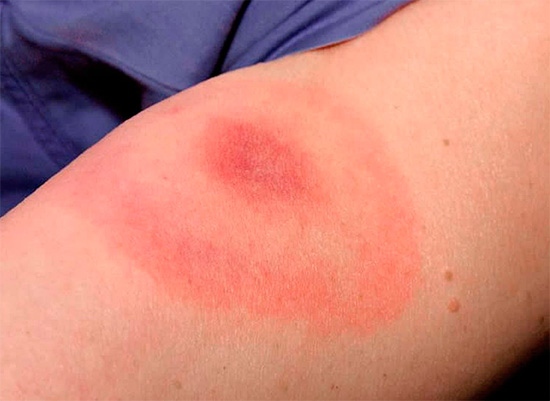 Låt oss prata om hur en allergisk reaktion av kroppen på insektsbett kan manifestera sig, liksom vilken fara den kan bära i vissa fall ...