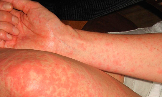 Ak sa po bodnutí osou objaví žihľavka, môže to byť jeden z príznakov nebezpečnej alergickej reakcie.