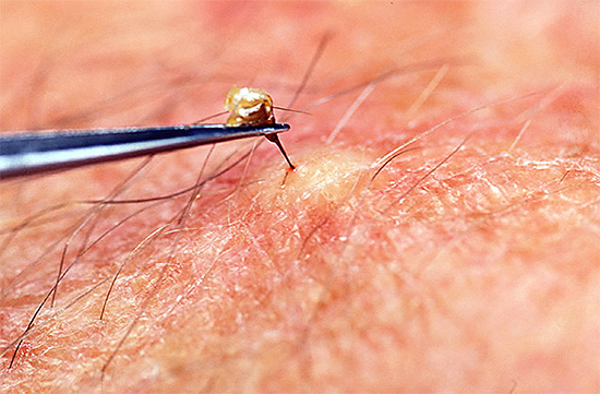 La puntura rimasta nella pelle deve essere rimossa il più rapidamente possibile in modo che nuove porzioni di veleno non entrino nella ferita.