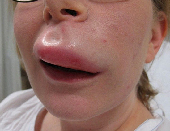 In alcuni casi, una puntura di vespa può diventare pericolosa per la vita a causa del blocco delle vie aeree (ad esempio, l'edema di Quincke).