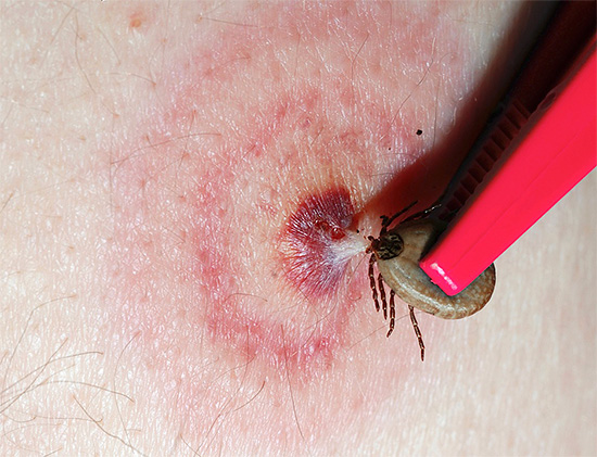 Une telle marque de morsure sous la forme d'anneaux rouges concentriques est généralement un signe d'infestation par les tiques, vous devez donc vous rendre d'urgence à l'hôpital pour obtenir des conseils et un traitement.