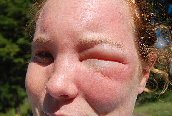 Les piqûres de guêpes au visage entraînent très souvent un œdème très prononcé, et les deux yeux peuvent se fermer en même temps.