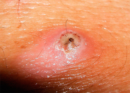 Autour de la puce de sable, qui a pénétré sous la peau, se développent généralement une inflammation et une suppuration sévères, pouvant aller jusqu'à la gangrène.