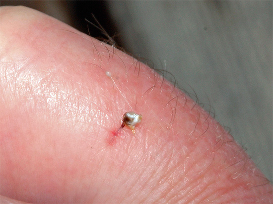 Au-dessus de la piqûre de l'abeille se trouve une poche de poison, il est donc important de ne pas appuyer dessus avec les doigts.