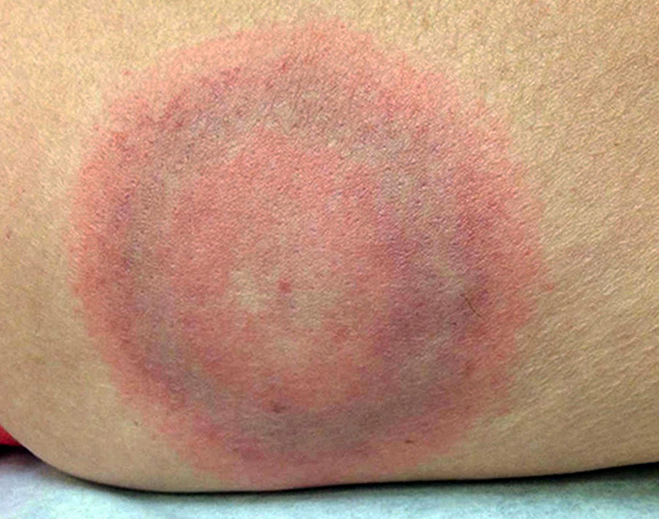 จุดดังกล่าว (วงแหวนวงแหวน) เป็นสัญญาณแรกของการติดเชื้อ Lyme borreliosis