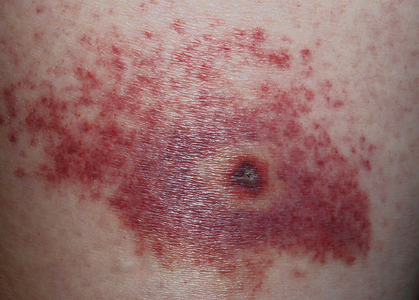 O tratamento antisséptico do local da picada não protege contra encefalite ou borreliose transmitida por carrapatos, mas reduz o risco de infecção secundária.