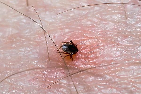 La foto mostra un segno di spunta che si è conficcato nella pelle di una persona.