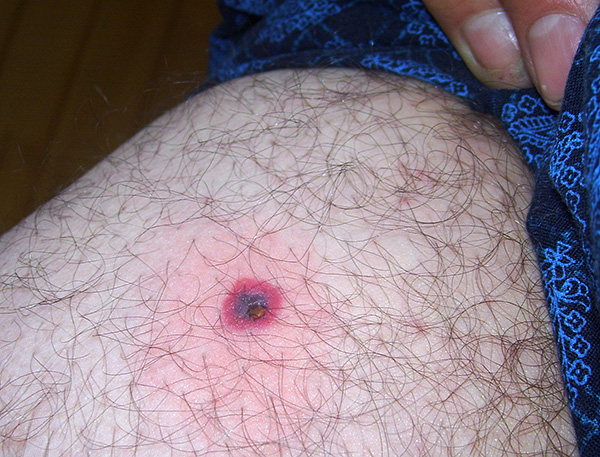 Le zecche Ixodid sono portatrici di malattie umane pericolose come l'encefalite da zecche e la malattia di Lyme (borreliosi).