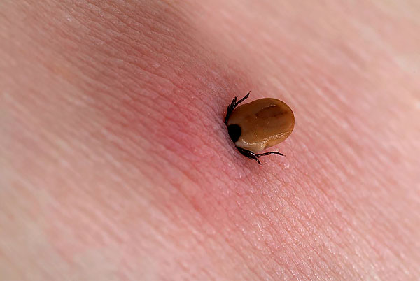 We find out how you can safely get a stuck tick from a person's skin ...