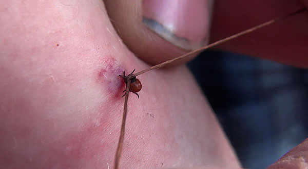 An example of extracting a stuck parasite with a thread.