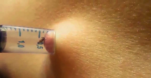 An example of extracting a tick with a syringe