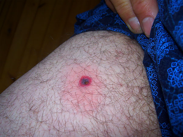 If the head of the parasite comes off, then it must be pry off with a needle and removed from the skin, like a splinter.