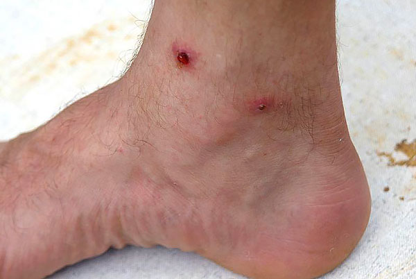 Festered and inflamed bites hurt for a long time and can become sources of bacterial infection in the body.