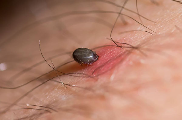 The integument of the tick's body is soft, and therefore it is dangerous to squeeze a satiated parasite strongly because of the risk of squeezing already infected blood and saliva into the wound.