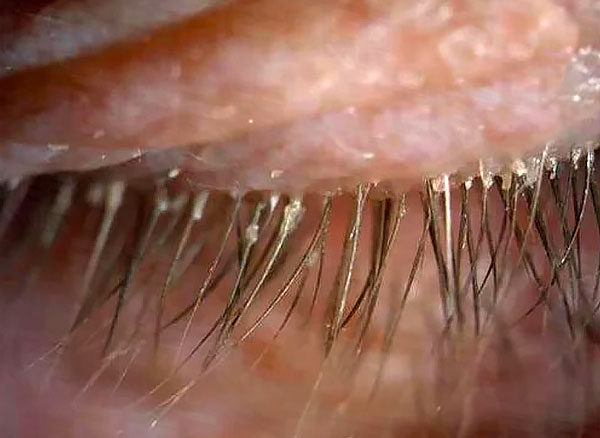 Un symptôme caractéristique de la démodécie est la décharge sur les cils.
