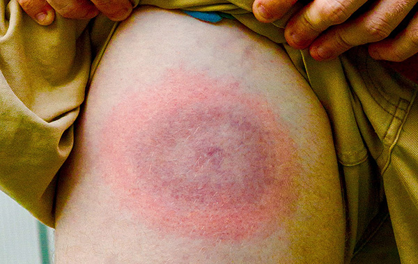 L'érythème migrant en anneau est un signe d'infection par la borréliose transmise par les tiques.