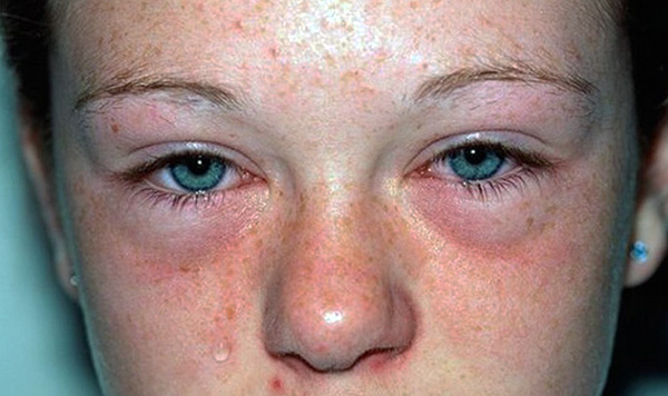 I segni di un'allergia alle zecche possono essere prurito costante della pelle, starnuti e lacrimazione, che sono aggravati dall'essere in casa.