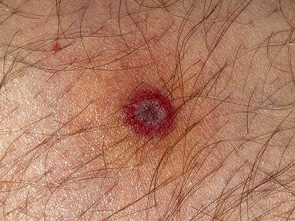 Núdzovú prevenciu kliešťovej encefalitídy má zmysel robiť len v prvých dňoch po uhryznutí, a potom už toto opatrenie nebude účinné.