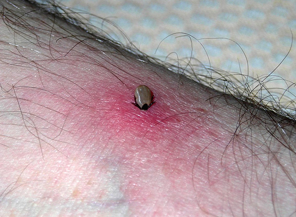 Quanto mais tempo o carrapato suga o sangue, maior o risco de transmissão de infecção (se o parasita for seu portador).