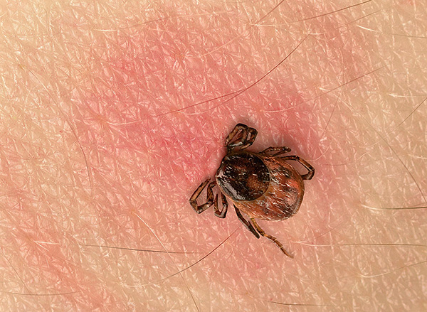 Une injection d'urgence permet de se protéger contre la TBE avec une forte probabilité, même si une personne a été mordue par plusieurs tiques infectées à la fois.
