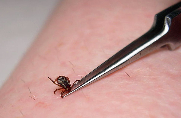 Usar uma pinça de unha comum para remover um sugador de sangue não é muito conveniente.