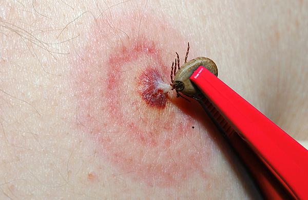 Pozrime sa, ako uhryznutie kliešťom vyzerá normálne a kedy môžeme hovoriť o nebezpečnej infekcii, ktorá sa stala ...
