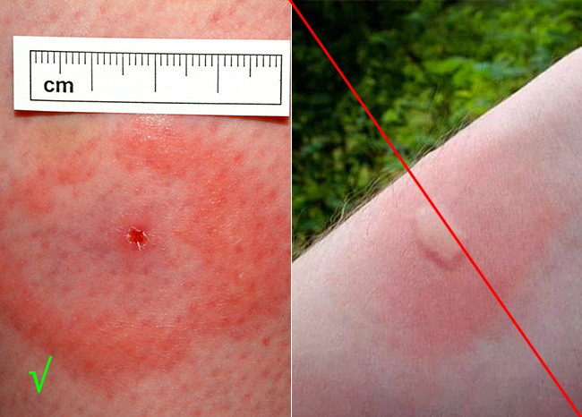 Vľavo je stopa po uhryznutí kliešťom, vpravo - od uhryznutia komárom.