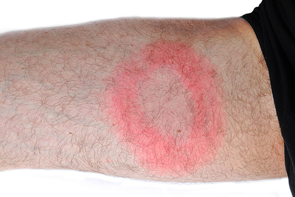 Ďalší príklad erythema migrans.