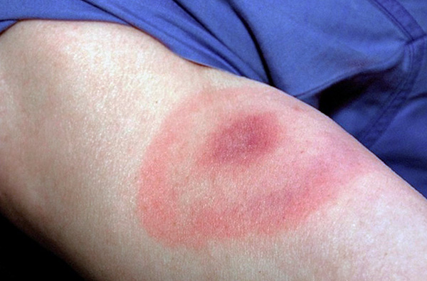Parece eritema anular migratório - um sinal de infecção com borreliose de Lyme.