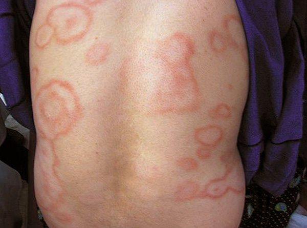 O eritema anelar também pode aparecer em áreas do corpo onde não houve mordidas.