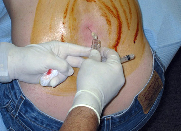 Seleção do líquido cefalorraquidiano para verificar a presença de patógenos da borreliose nele.