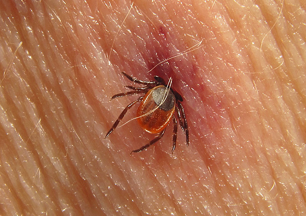 A encefalite transmitida por carrapatos e a borreliose de Lyme geralmente levam à incapacidade de uma pessoa doente.