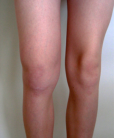 ผลที่ตามมาของ Lyme borreliosis